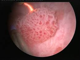 The symptoms of stage 4 bladder cancer include tiredness, weakness, and pain. Urinary Tract Cancer Amboss