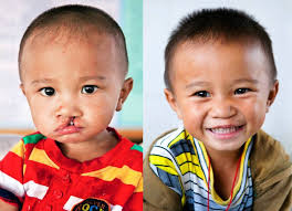 We Shall Never Know All The Good That A Simple Smile Can Do Mother Teresa Bao Before And After Cleft Lip Surger Operation Smile Lip Surgery Cleft Lip