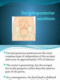 Image result for Manual Rotation in Occipitoposterior Presentation