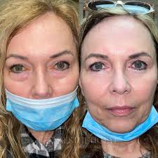 🥇 Cincinnati and Dayton OH Eyelid Surgery