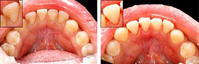 Some things you can do at home are to brush your teeth twice daily with fluoride toothpaste, floss after meals, and use antiseptic mouthwash. Periodontal Disease Rigby Dental Cedar Creek Dental