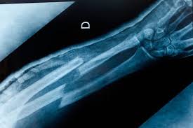 Types Of Broken Bones Orthopedics Henry Ford Health System Detroit Mi