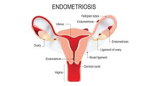 Stage iv or severe stage: Endometriosis The 4 Stages Treatment Options Medicine Com