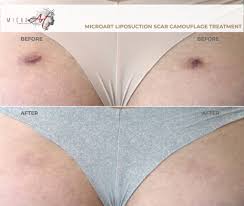 Find this pin and more on tummy tuck tattoos by carpink72. Scar Treatment By Microart Semi Permanent Makeup Camouflages Scars