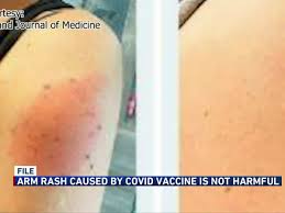 A minority of patients may experience a large, red, sometimes raised, itchy or painful skin reaction, according to researchers at massachusetts general hospital (mgh) in boston. Those Receiving Moderna Vaccine May Experience Covid Arm