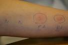 Hauttests - BENCARD ALLERGIE