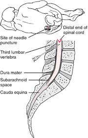 Medical terminology add ons and definitions (07/28/21). Quincke Puncture Definition Of Quincke Puncture By Medical Dictionary