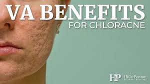 Cases of chloracne were noted in seveso, italy, following an explosion at an herbicide plant in 1976 and in the intentional poisoning of an ukrainian presidential candidate in 2004 with dioxin. Va Disability Benefits For Chloracne Hill Ponton P A