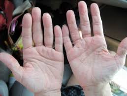 It S Simple Who Gets Dactylitis Or Sausage Finger Rheumatoid Arthritis Warrior Arthritis In Fingers Swollen Hands Psoriatic Arthritis
