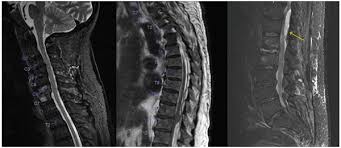 Image result for Spinal Infection