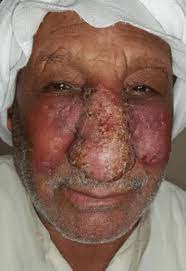It is the most common m. Lupus Vulgaris Like 67 Years Old Male Patient Present With History Of Download Scientific Diagram