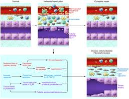 Chronic kidney disease can be caused by things like hypertension, infection, diabetes, or immune disorders. Jci Cellular Pathophysiology Of Ischemic Acute Kidney Injury