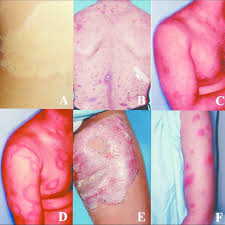 Clinical Signs Associated With Leprosy In Various Stages Of The Download Scientific Diagram