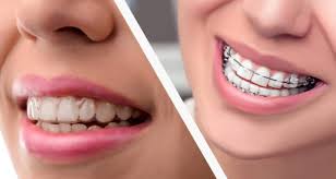 After braces come off, most people need to wear a retainer all the time for the first 6 months. Can You Get Invisalign After Braces Stanley Dentistry