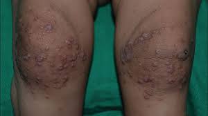 Image result for sweat rash on back