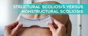 Exercise and stretches are a vital part of treatment and can help relieve pain. Structural Scoliosis Vs Nonstructural Scoliosis