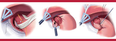 Maybe you would like to learn more about one of these? Laparoscopic Anti Reflux Gerd Surgery Patient Information From Sages