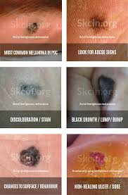 Image result for Acral lentiginous melanoma nail