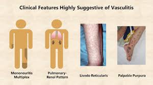 Image result for Vasculitis