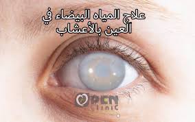 علاج المياه البيضاء في العين بدون تدخل جراحي اوبن كلينيك Openclinic