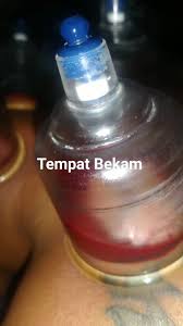 Pijat Panggilan Kopo 085881174792 | Bandung