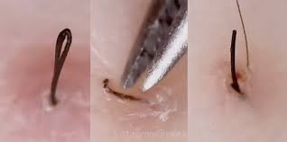 It can cause inflammation, pain and tiny bumps in the area where the hair was removed. Tweezist Is An Instagram Account Dedicated To Tweezing Out Ingrown Hairs