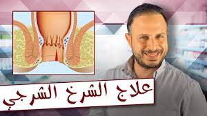 علاج الشرخ الشرجي بوصفة سهلة وسريعة youtube