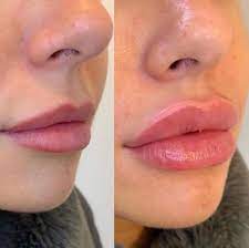 Du hyaluron pen est un traitement qui permet de réaliser des injections d'acide hyaluronique pour vous dans ce guide indépendamment de votre type d'habitation des lèvres tout en réalisant d'importantes économies alors,les climatiseurs réversibles sans groupe extérieur de 2020 juice plus test et avis. Hyaluron Pen Levres A Montpellier 34 Par Amel Estheca