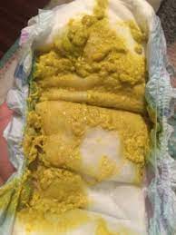 Caca Con Moco Bebe Club De Bebes Junio 2018 Babycenter