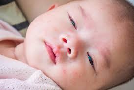 Eczema exfoliation is just one step in a healthy skin care routine. Dry Skin On A Baby S Face Causes And Remedies