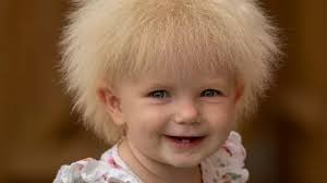 Tot with rare condition that leaves her unable to COMB her hair compared to  Boris Johnson