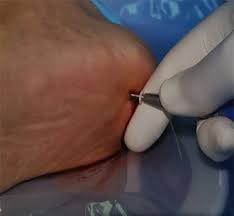 If the pain is on the bottom of the heel, plantar fasciitis is most likely the reason. Heel Spur Pain