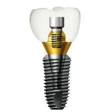 Chi phí trồng răng Implant