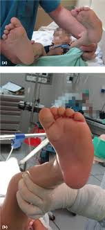 In most cases, clubfoot twists the front of the foot downward and inward, increasing the arch and turning the heel inward. Treatment Of Relapsed Residual And Neglected Clubfoot Adjunctive Surgery Journal Of Children S Orthopaedics