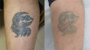 You can also mix honey, aloe vera, salt, and yogurt to create a paste that will help with natural tattoo removal in a similar way to plain aloe vera. Best Tattoo Removal For Green Ink Laser Skin Care Clinic