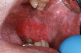 Image result for Erythroplakia roof of mouth
