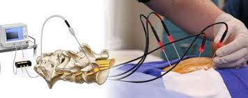 Image result for Radiofrequency Surgery