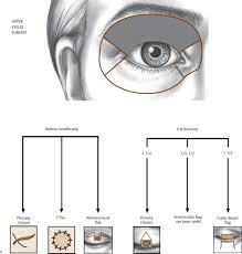 Image result for Eyelid Closure Defect