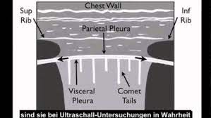 Als fachkrankenhaus und akutklinik behandeln wir menschen im alter von 18 bis über 70 jahren mit einer psychosomatischen diagnose. Anleitung Ultraschall Bei Pneumothorax Fallstudie Youtube