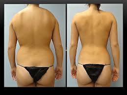 Waist Liposuction Before And After Photos Low Cost Liposuction In Greece Turkey And Bulgaria Http Www Jmb Medic Liposuction Abdominoplasty Liposuction Cost