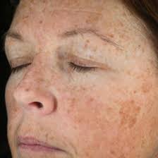 Although sunspots are harmless, some people may want to get rid of them or. Sun Damage Brown Spot Laser Treatment Cynosure