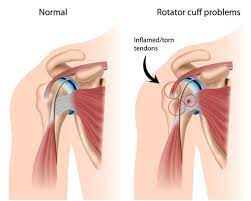 Maybe you would like to learn more about one of these? Is Your Shoulder Pain Coming From The Rotator Cuff Loudoun Sports Therapy Centerloudoun Sports Therapy Center