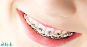 الدعامات السنية وتقويم الأسنان ويب طب
