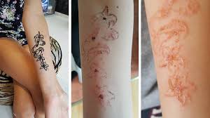 Think of it as a temporary tattoo. Girl Could Be Scarred For Life After Black Henna Tattoo Goes Horribly Wrong