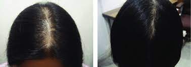 What to do about hair thinning at the front of your head. Thinning Of The Hair On The Crown Of A 22 Year Old Woman Limited In Download Scientific Diagram