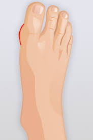 Hallux Valgus Stadien Hallux Info