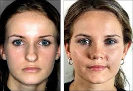 Cosmetic Surgery Loans 15 Nose Reshaping Perfect Nose Rhinoplasty Nose Jobs