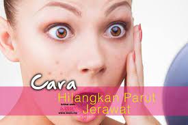 Campurkan 2 sudu teh baking soda dengan sedikit air, jangan cair sangat. Cara Hilangkan Jerawat Home Facebook