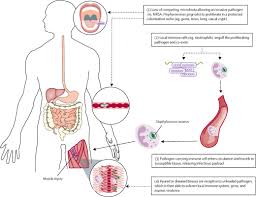 $10,000 income in excess of limit x 50% ($1 reduction for every $2 over limit) equals a $5,000 benefit reduction. Re Examining Causes Of Surgical Site Infections Following Elective Surgery In The Era Of Asepsis The Lancet Infectious Diseases
