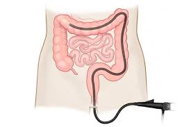 Maybe you would like to learn more about one of these? Kolonoskopiya Kishechnika Chto Eto Takoe Kak Delaetsya I Kak Podgotovitsya K Procedure